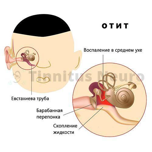Воспаление среднего уха – отит – сопровождается шумом