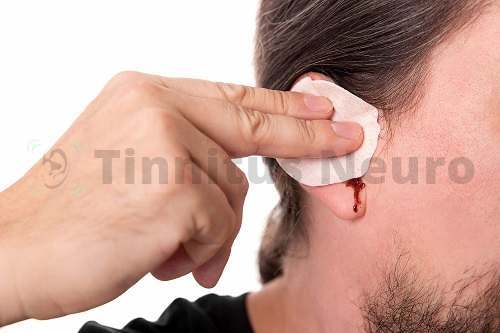 Шуметь в ушах может после травмы