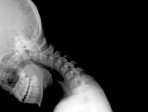 Выявить дисфункцию позвоночного столба – одну из причин слабости и шума в голове – можно на рентгенснимке