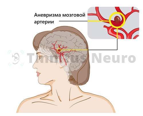 Если голова болит и шумит, нужно исключить аневризму мозговых сосудов