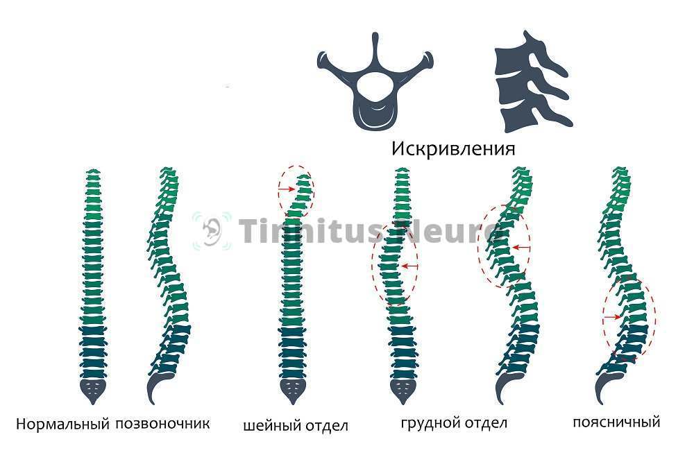 Нестабильный позвоночник приводитк разныи расстройствам здоровья