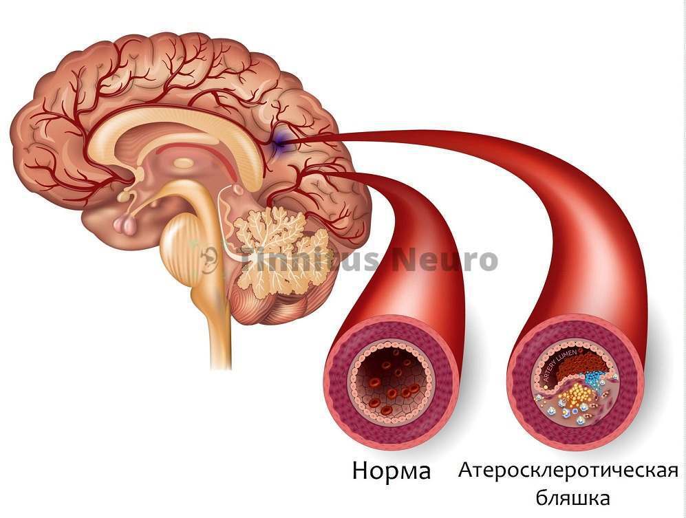 Без лечения атеросклероза иногда невозможно помочь пациентам с шумом в ушах