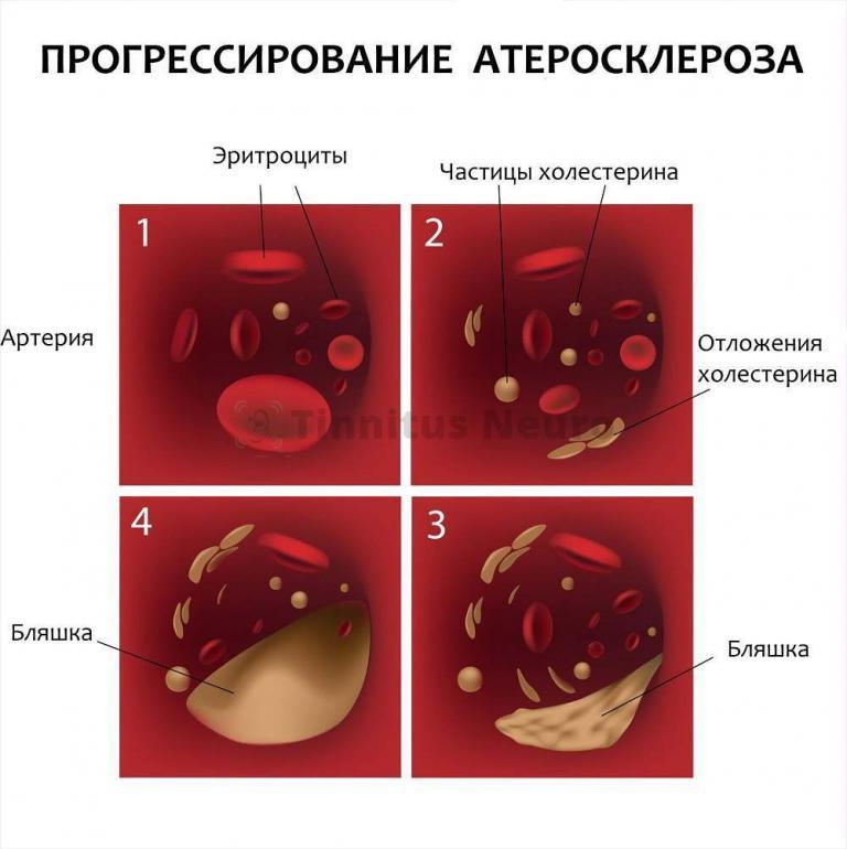 Лечение атеросклероза сосудов головного мозга народным средствами.