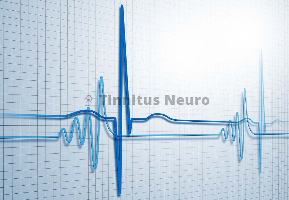 Примерно так выглядит ЭКГ
