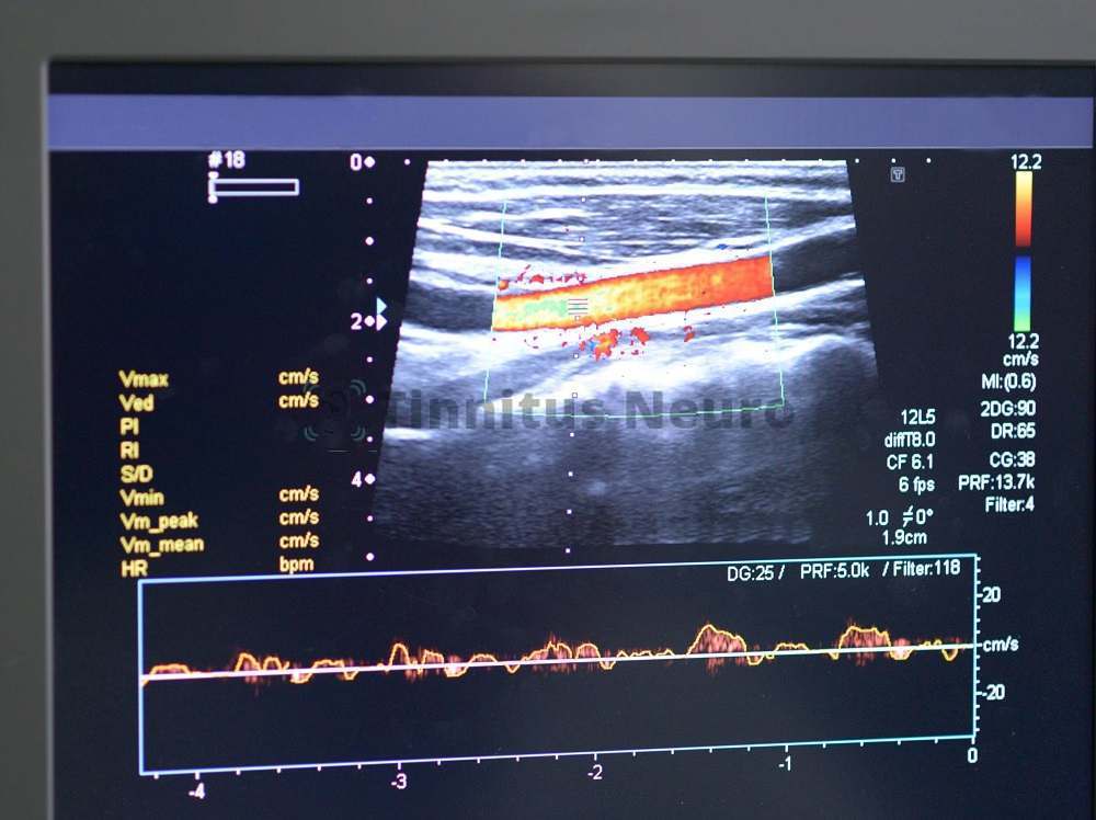 Кровоток в сосуде на допплерографии
