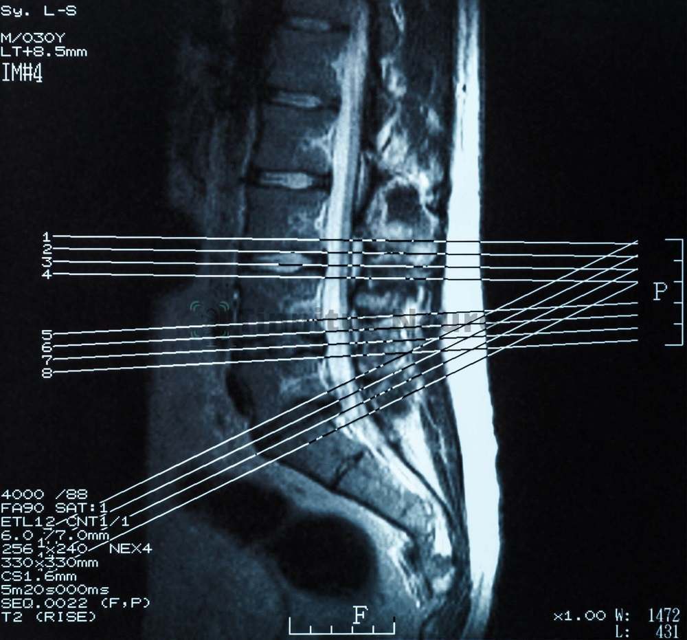 Позвоночник на МРТ