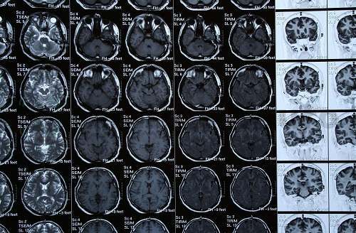 Обычная МРТ не покажет активность отделов мозга