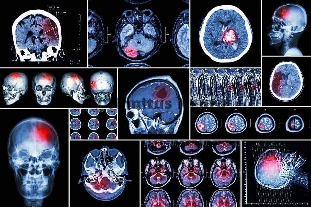 МРТ головы показывает причину шума в ушах