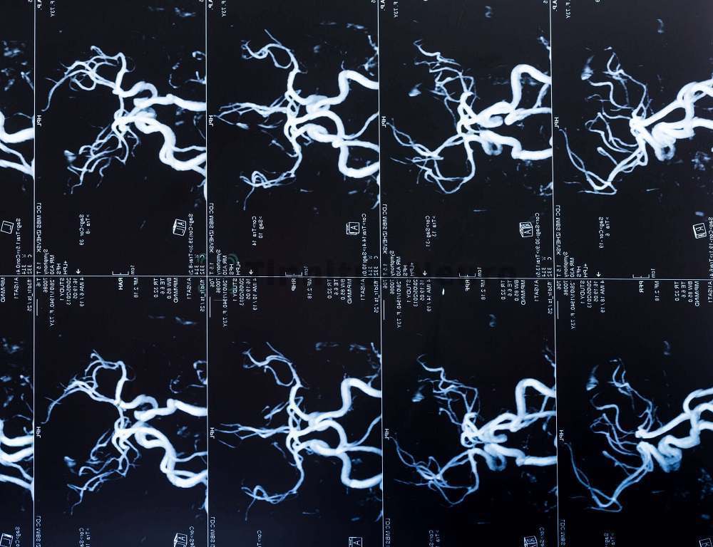 Сосудистая патология мозга выявляется на МРТ