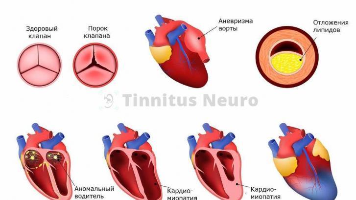 Расшифровка ЭКГ выявляет ранние стадии болезней сердца