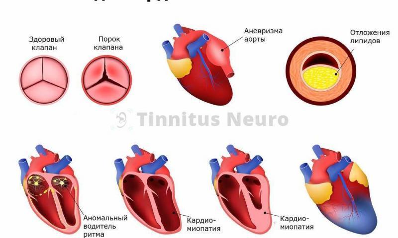 Расшифровка ЭКГ выявляет ранние стадии болезней сердца