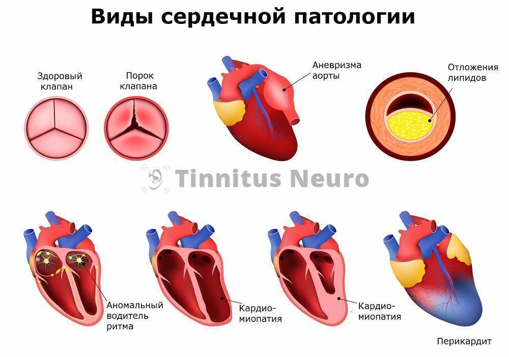 Расшифровка ЭКГ выявляет ранние стадии болезней сердца