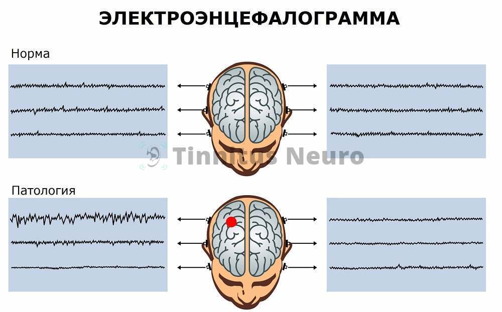 Нормальная ээг. Электроэнцефалограмма головного мозга нормы показателей. ЭЭГ норма и патология. ЭЭГ головного мозга норма и патология. ЭЭГ В норме и при патологии.