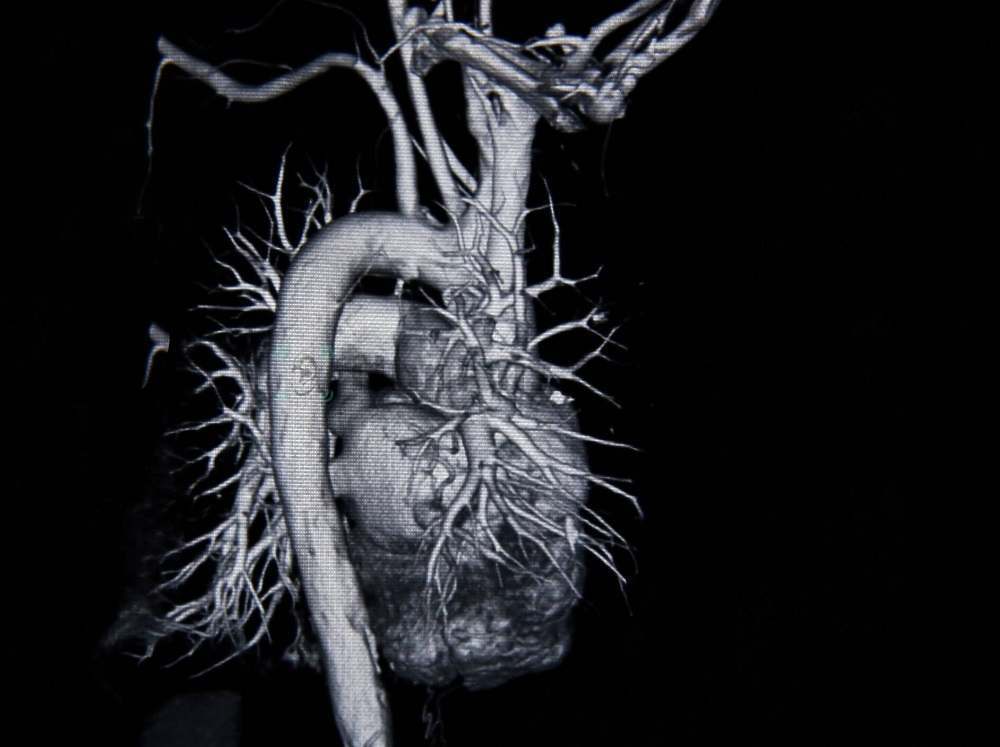 Артерии сердца и крупные стволы на МРТ