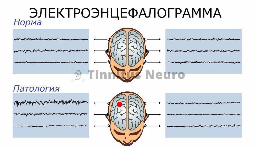 Электроэнцефалография - регистрация электрической активности мозга