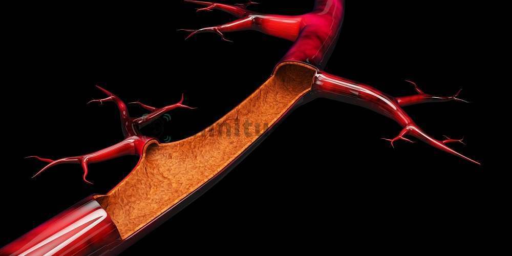 Чистый просвет артерии