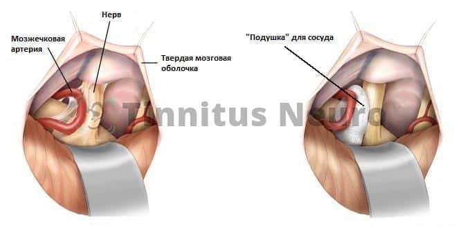Операция при нейроавскулярном конфликте