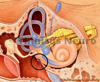 Свищ лабиринта Отверстие в канальце - причина шума в ушах