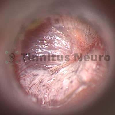 Тимпаносклероз - причина шума в ушах