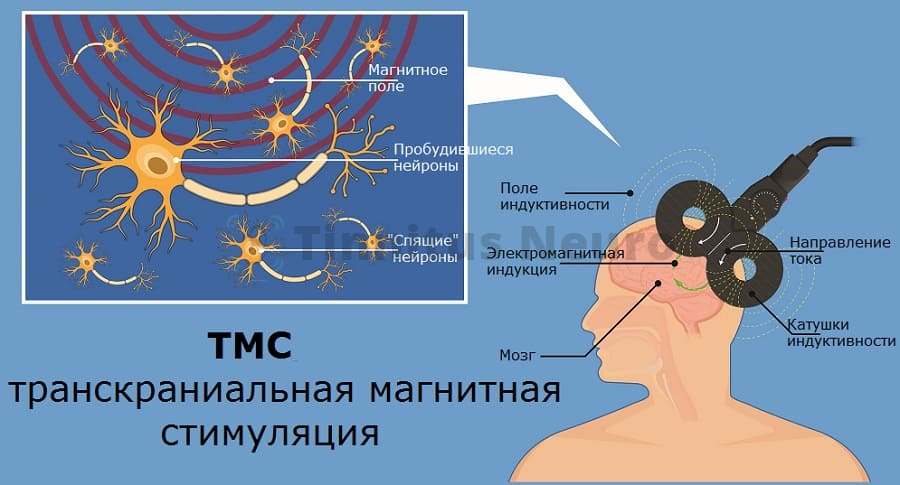 ТМС лечение тиннитуса в клинике