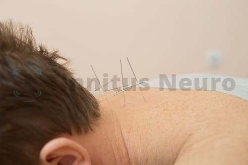 Рефлексотераапия иглоукалыванием в лечении тиннитуса